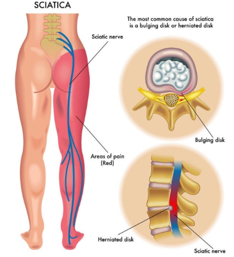 Điều trị thoát vị đĩa đệm cổ và lưng